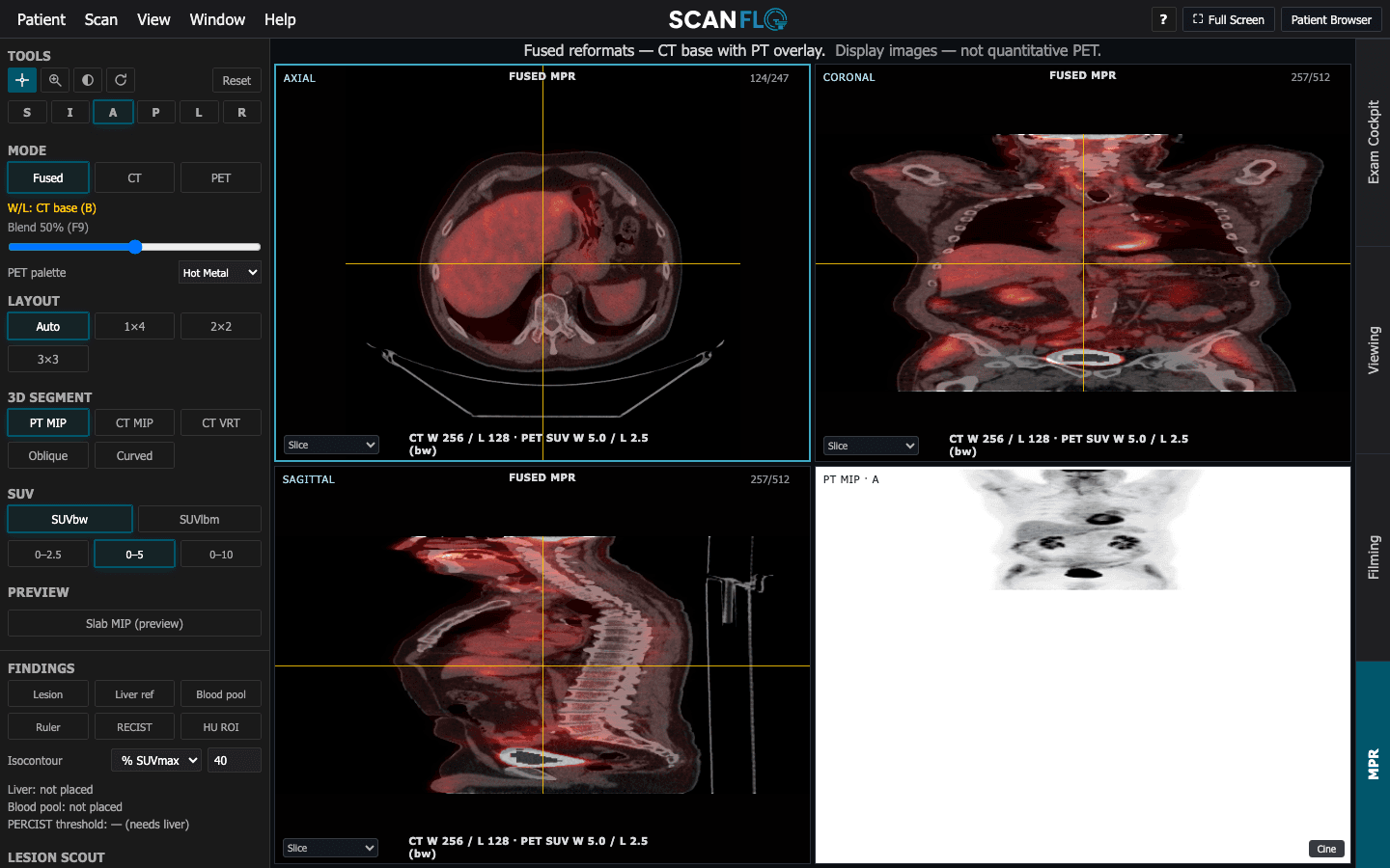 ScanFlo PET-CT MPR in fused mode: axial, coronal and sagittal reformats with the CT as base and FDG PET overlaid in a hot-metal palette at 50% blend, SUV body-weight window 0 to 5, and a PET maximum-intensity projection pane.