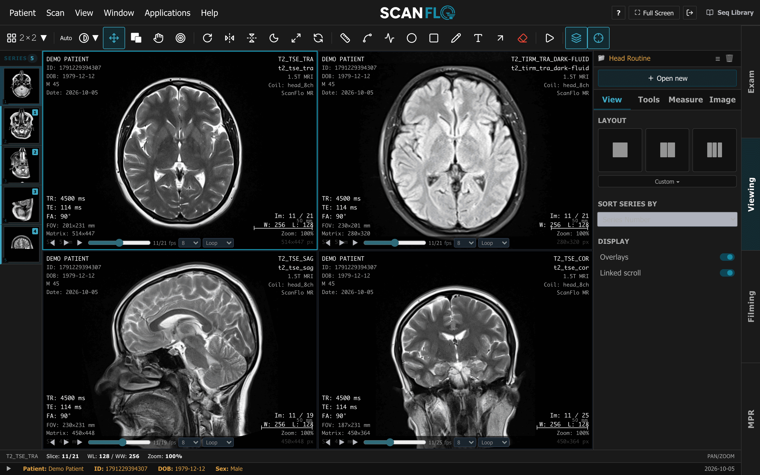 ScanFlo MRI viewing workspace in a 2×2 layout of a head study: axial T2, axial FLAIR, sagittal T2 and coronal T2, scrolling through the slices together with linked scroll
