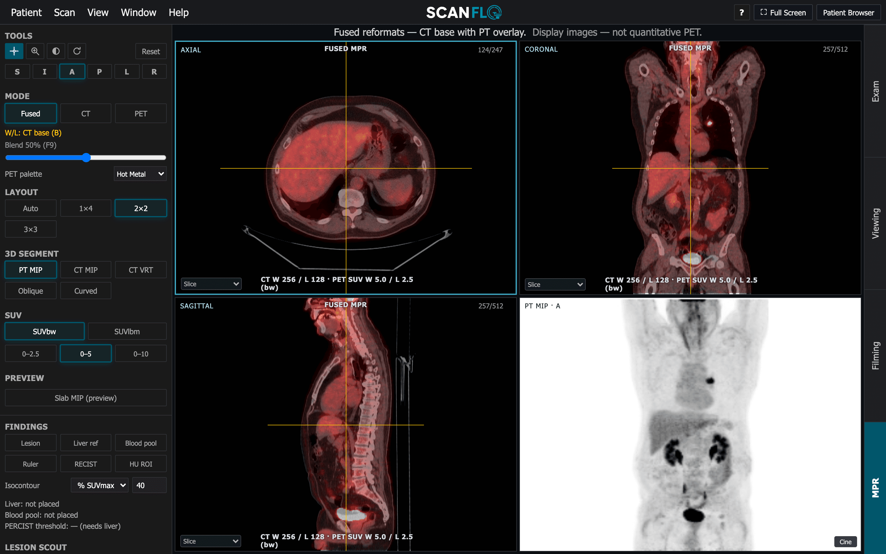 ScanFlo PET-CT findings tools: lesion, liver reference and blood-pool buttons, ruler, RECIST and HU ROI, a percent-of-SUVmax isocontour and the PERCIST threshold readout