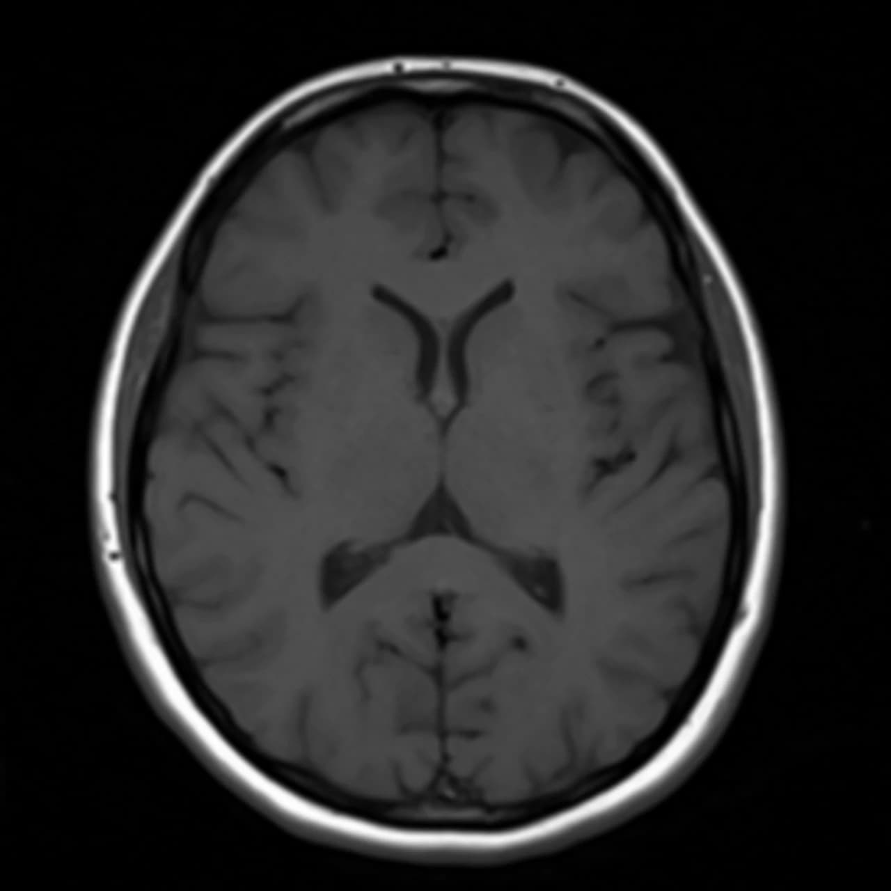 Axial T1 brain MRI from the ScanFlo console, real DICOM case, TR 400 ms