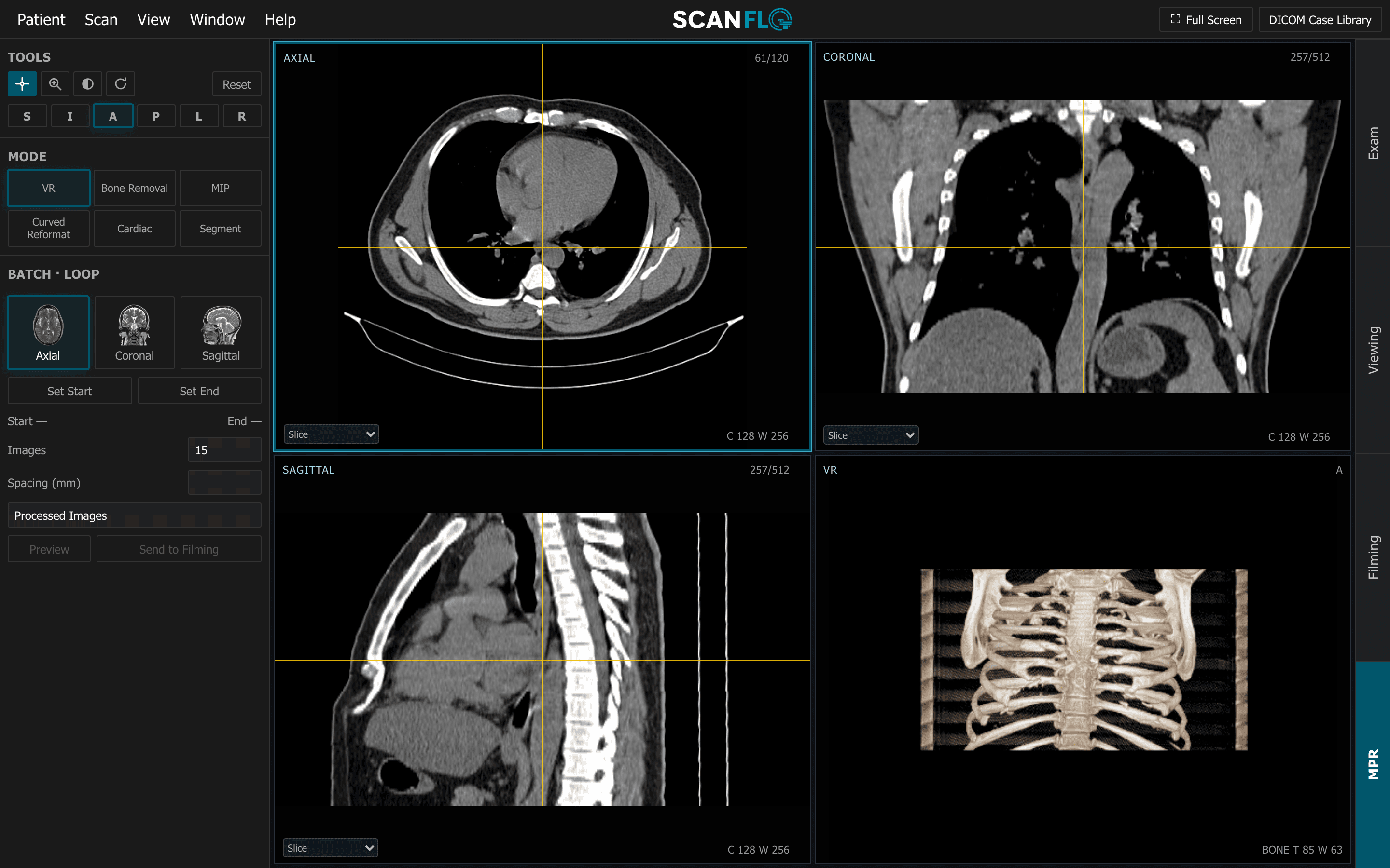 ScanFlo CT 3D workspace with axial, coronal and sagittal chest reformats, a linked crosshair, and a bone volume render of the thorax