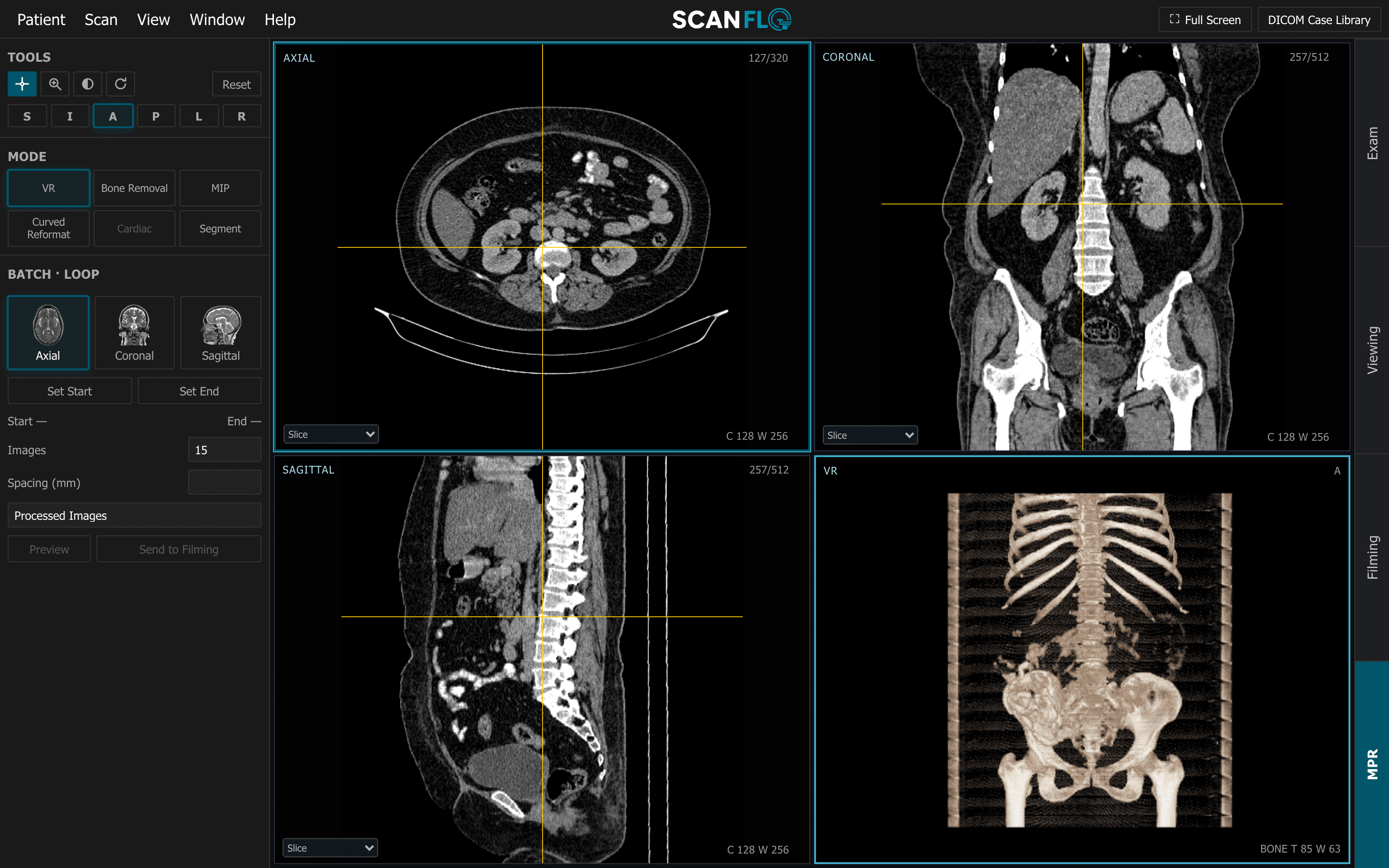 ScanFlo CT 3D workspace on a contrast abdomen: axial, coronal and sagittal reformats beside a bone volume render of the spine and pelvis, turning
