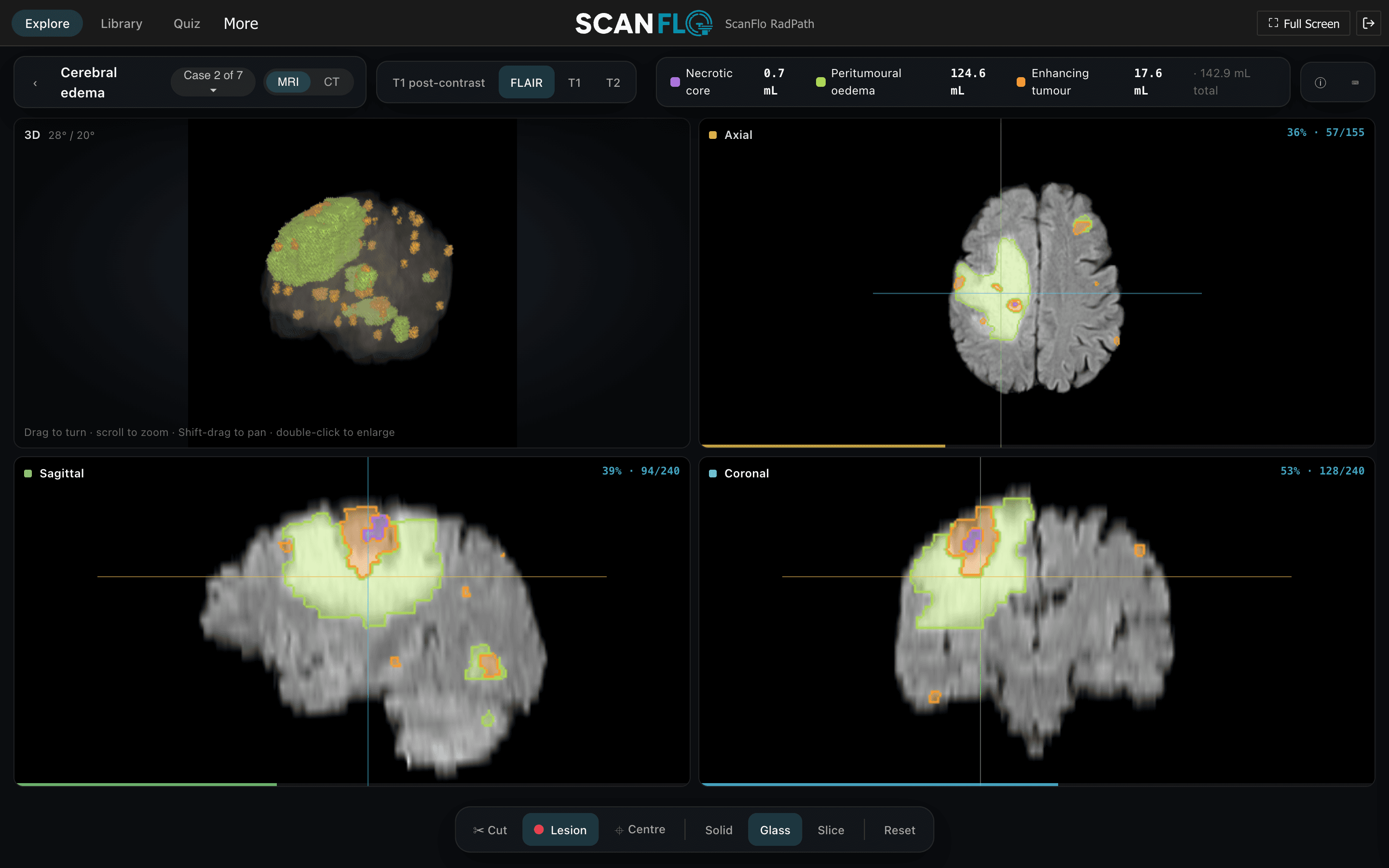 ScanFlo RadPath: a cerebral edema MRI case with the lesion outlined in 3D and in axial, sagittal and coronal planes, scrolling through the axial slices