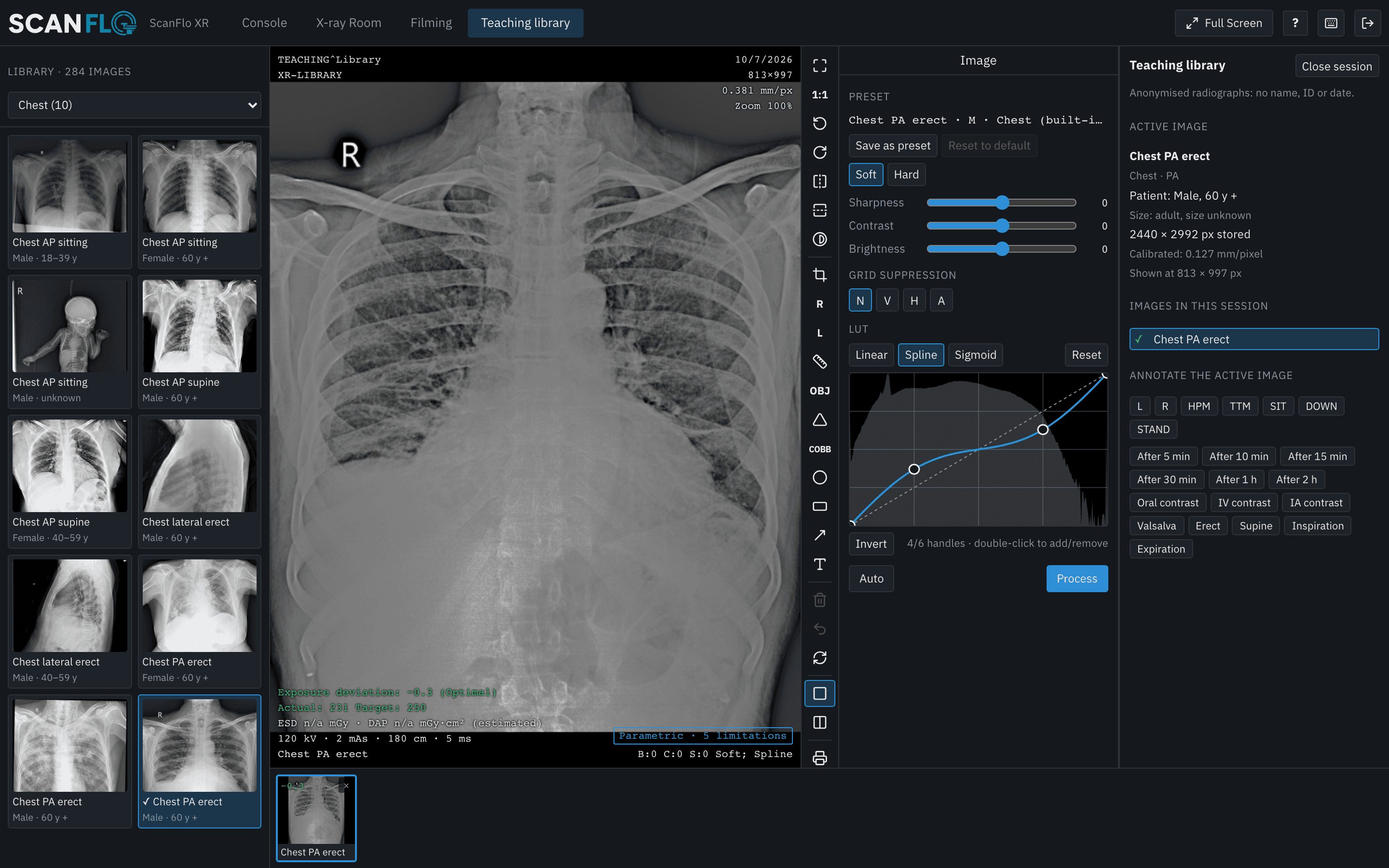ScanFlo XR workstation with a real, anonymised chest PA radiograph from the teaching library: the deviation index and exposure index, kV, mAs and SID, the processing curve and grid suppression, and the library of chest projections