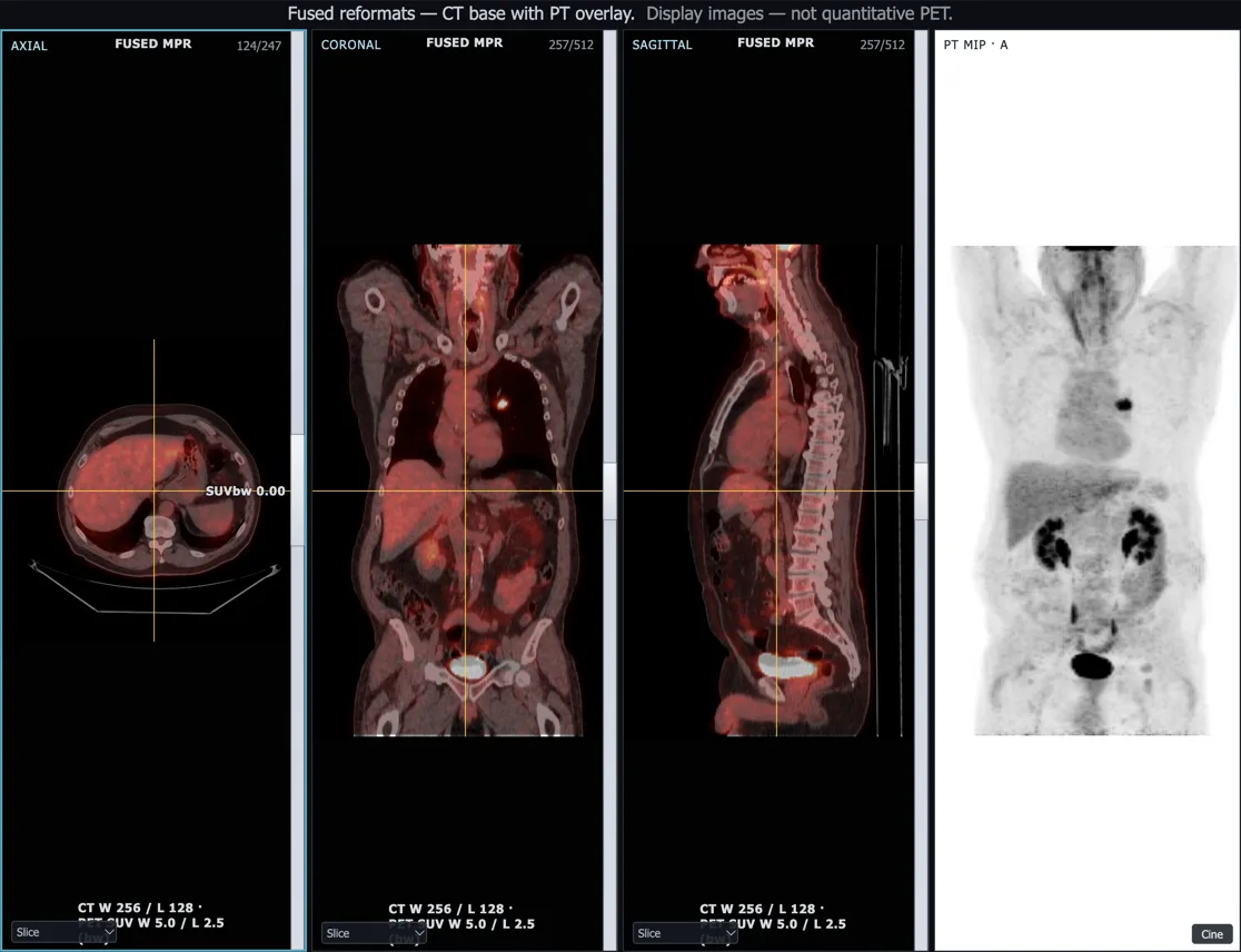 Fused PET and CT images in axial, coronal and sagittal planes with a red PET overlay on grey CT, and a whole-body PET maximum intensity projection on the right showing normal uptake in the brain, kidneys and bladder and a small focus in the chest.
