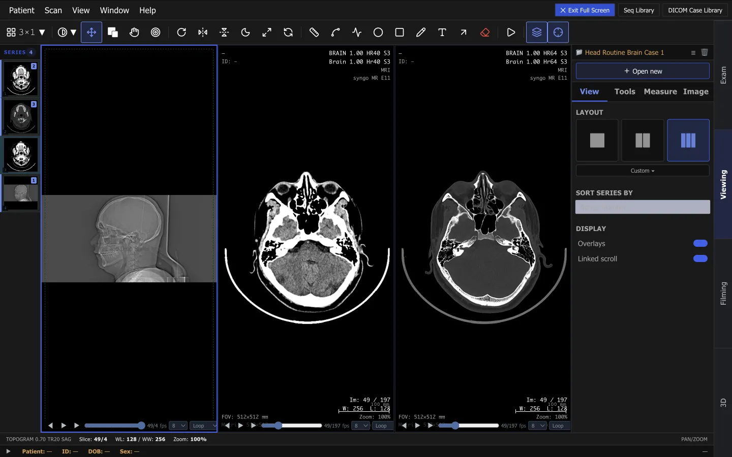 ScanFlo CT viewing workspace comparing the same axial brain slice reconstructed with a soft-tissue kernel and a bone kernel side by side.