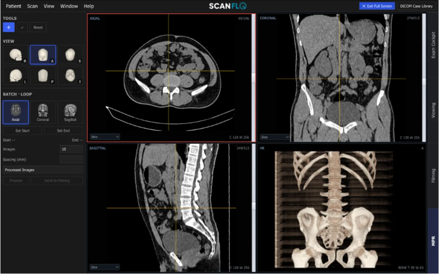 ScanFlo CT MPR workspace with axial, coronal and sagittal abdomen reformats, a linked crosshair, and a 3D bone volume render of the spine and pelvis.