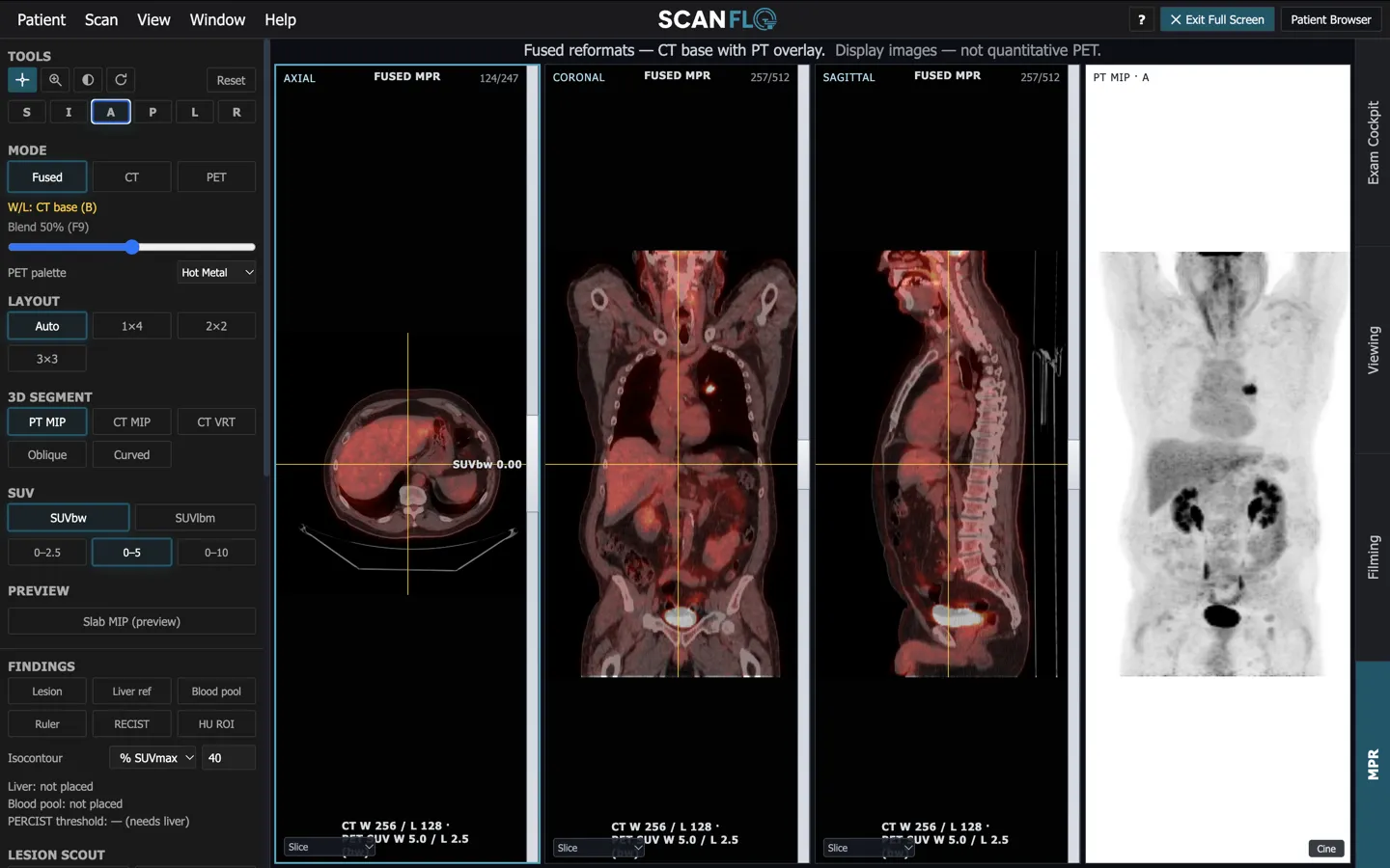 ScanFlo PET-CT MPR workspace: fused PET/CT axial, coronal and sagittal reformats with a 50% blend, a rotating whole-body PT MIP, SUV windows and findings tools.